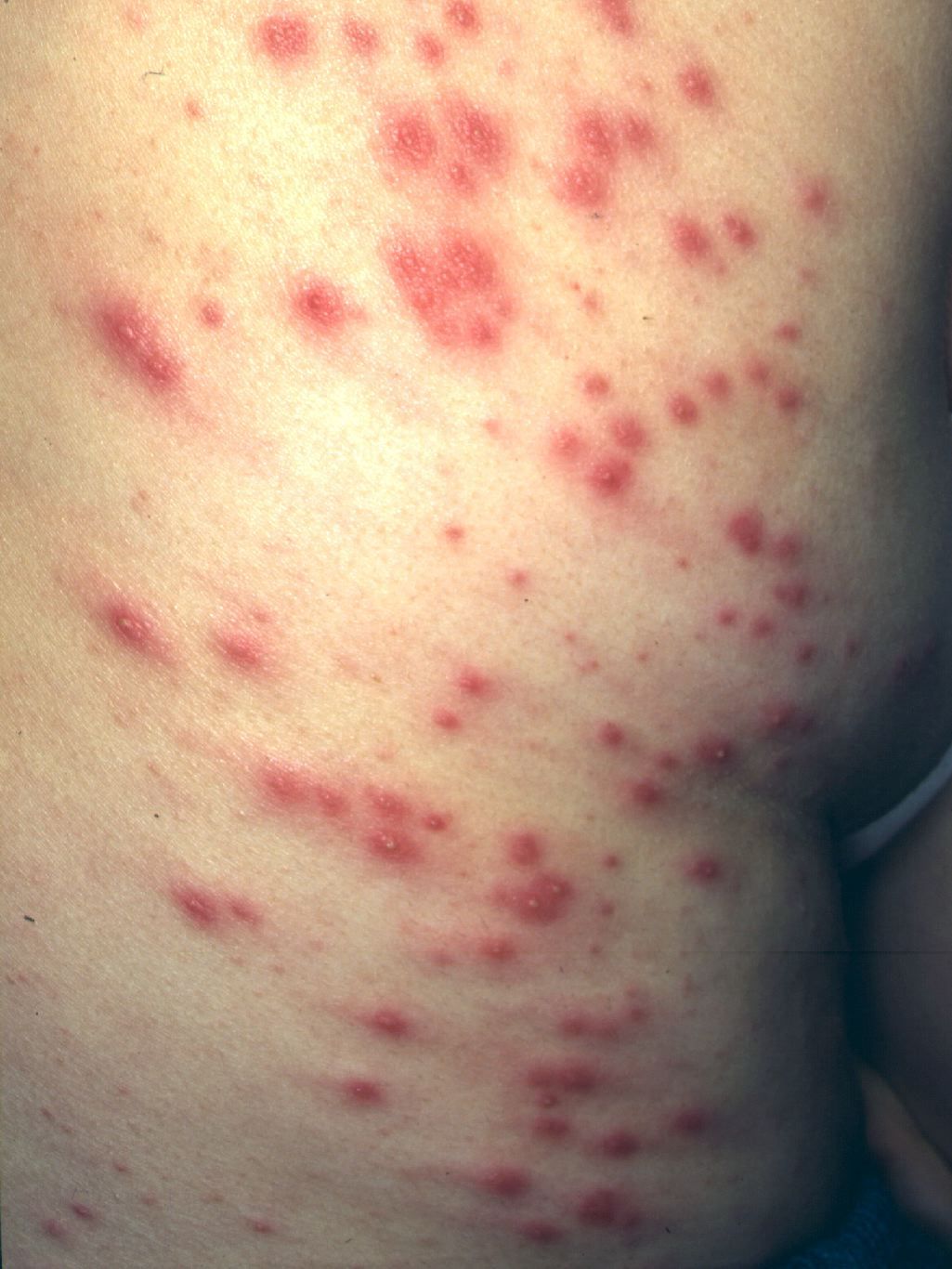 Folliculitis skin redness